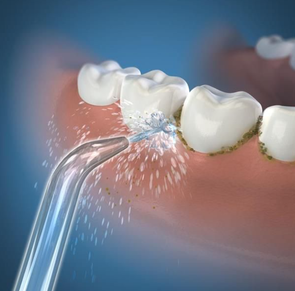 Waterpik Capat Pentru Dus Bucal Acc Dus Bucal Jt 450e