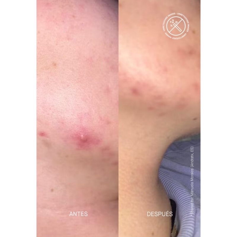 Zitcontrol Crema Pentru Ten Acneic Cu Niacinamide Si Acid Salicilic, 40 ml, Acnemy Zitcontrol Crema Pentru Ten Acneic Cu Niacinamide Si Acid Salicilic, 40 ml, Acnemy