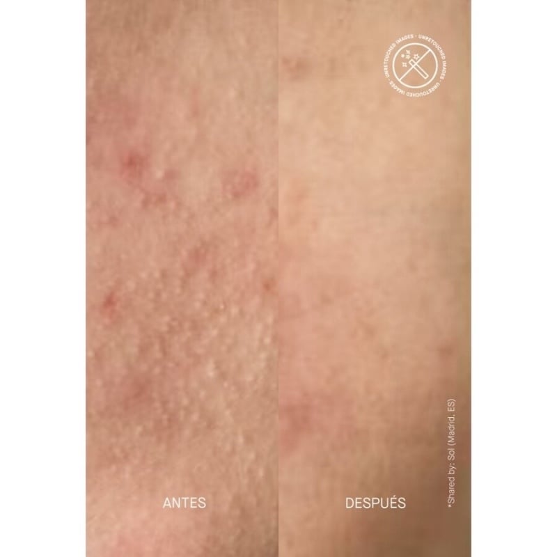 Zitmask Masca De Fata Pentru Semne Post-Acneice Cu Bha Si Sulf, 100 ml, Acnemy Zitmask Masca De Fata Pentru Semne Post-Acneice Cu Bha Si Sulf, 100 ml, Acnemy