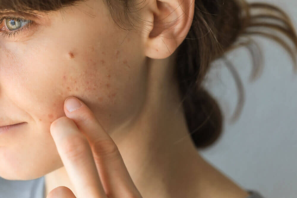 Microbiomul și acneea