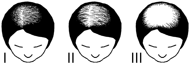 Alopecia la femei - scorul Ludwig